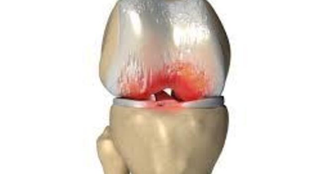 The Hidden Connection Between Constipation and Arthritis image