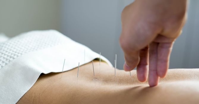 Acupuncture for Insomnia