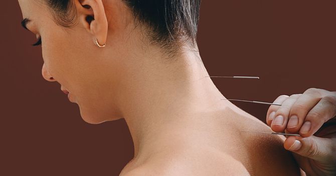 Acupuncture for Insomnia