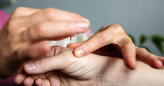 Acupuncture for Insomnia image
